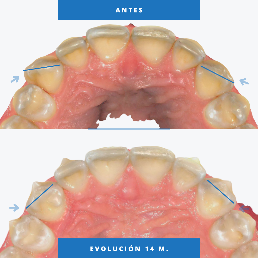 Canine Derotation with Clear Aligners: Possible or Predictable?